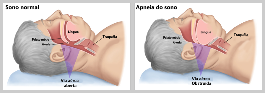 sono com apneia 