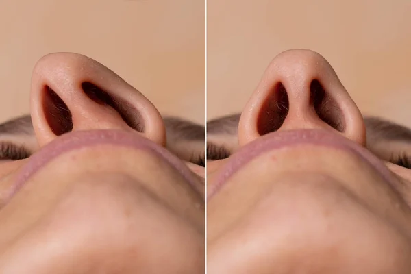 estetica nasal-rinoplastia