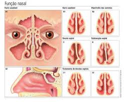 desvio de septo nasal