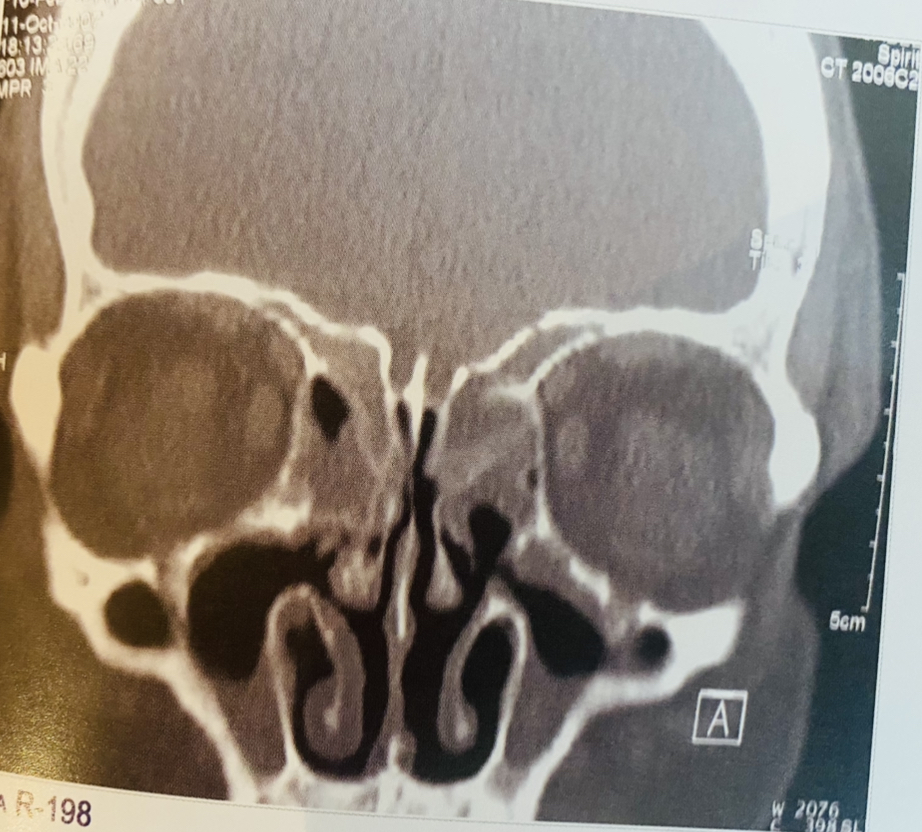obstrução nasal